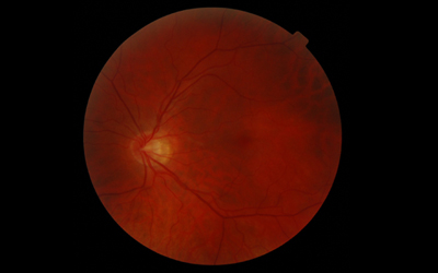 Retina?