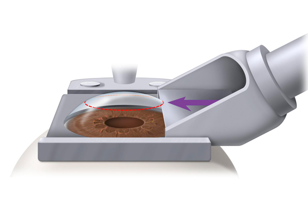 Microkeratome LASIK