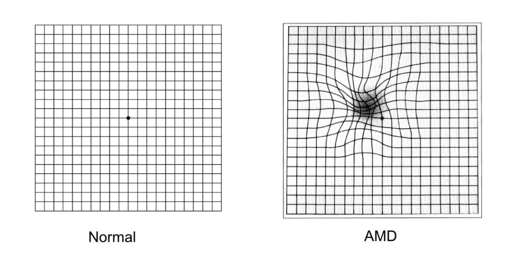 Amsler grid distortions for normal people and those with Age-related Macular Degeneration (AMD)