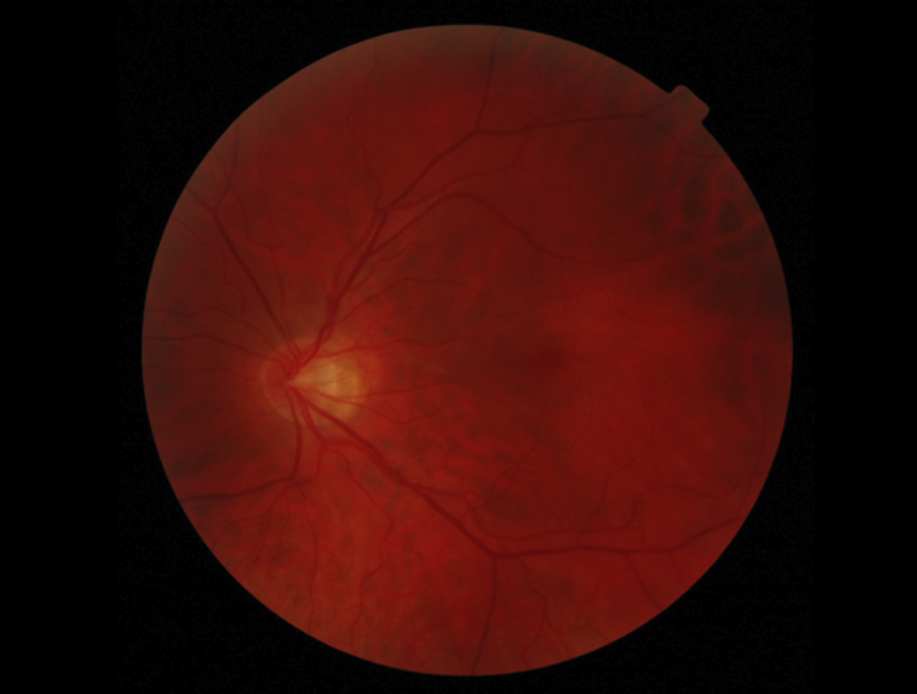 Age-related Macular Degeneration