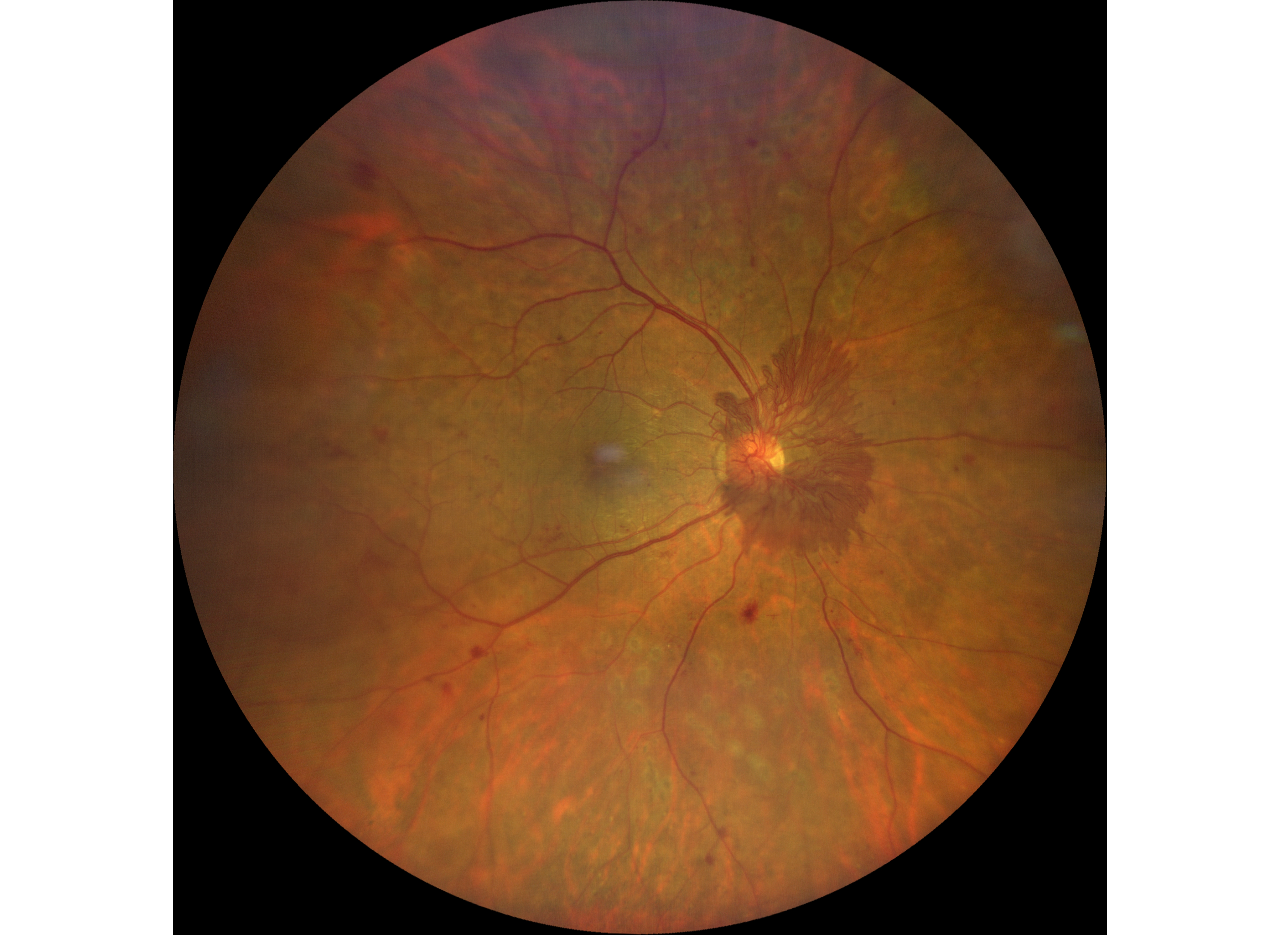 Diabetic Retinopathy