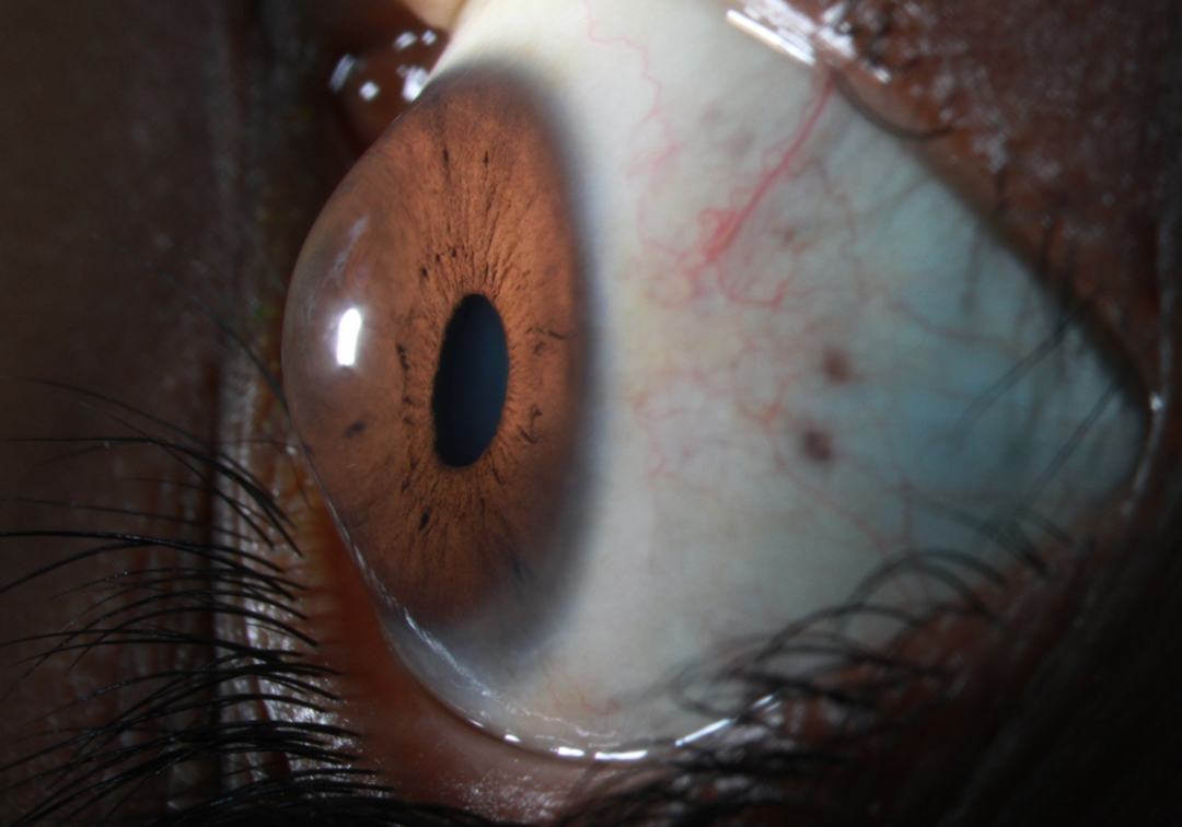 keratoconus
