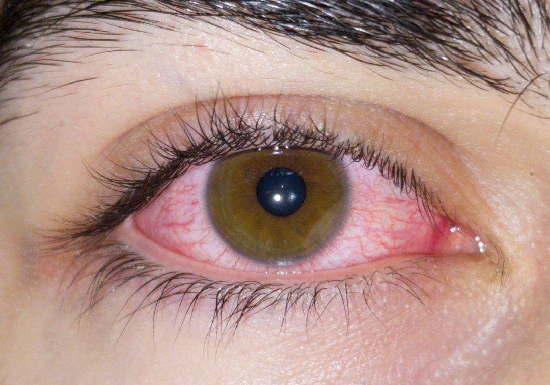 Red eye