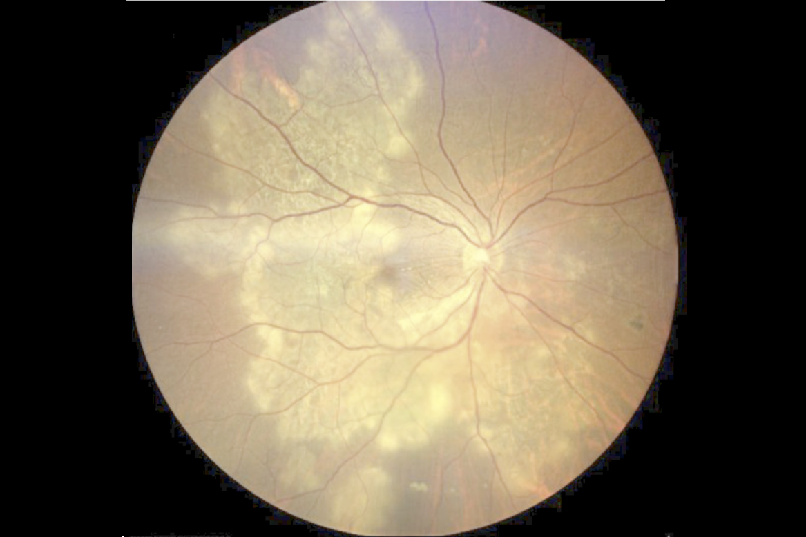 Retinal scan of an eye with tubercular serpiginous-like choroiditis (TB-SLC).