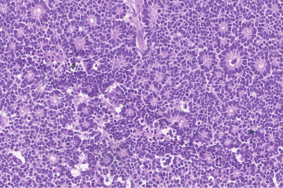 Photomicrograph shows a well differentiated retinoblastoma with Flexner - Wintersteiner and Homer - Wright rosettes.