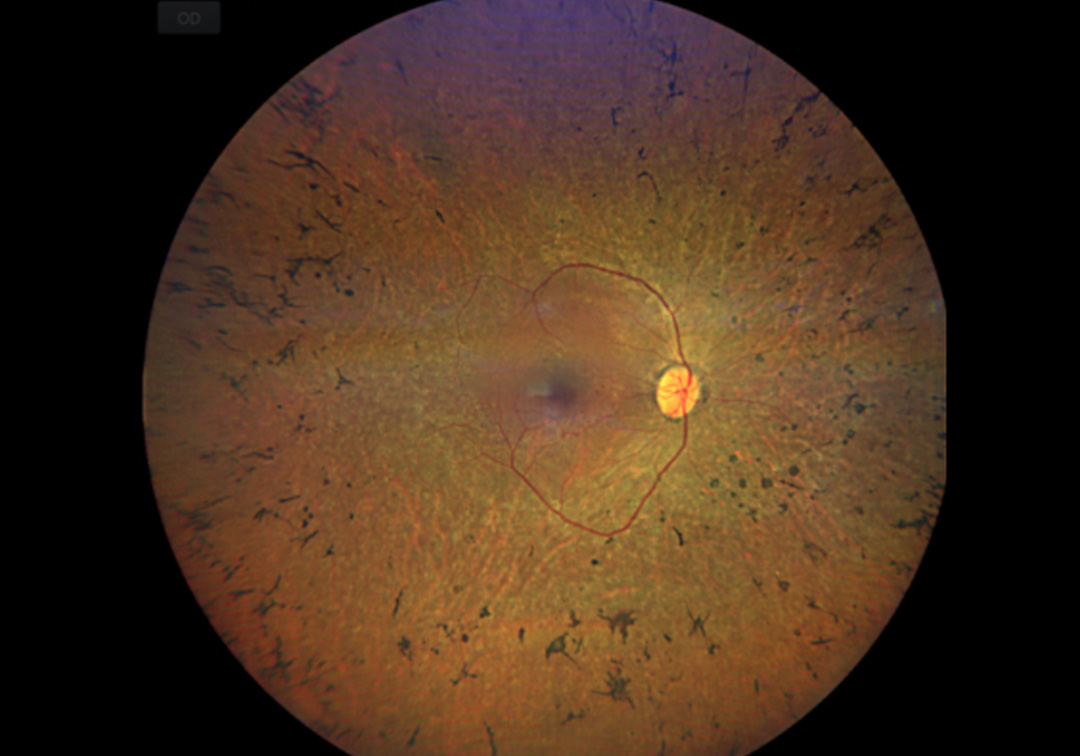 Retinitis Pigmentosa