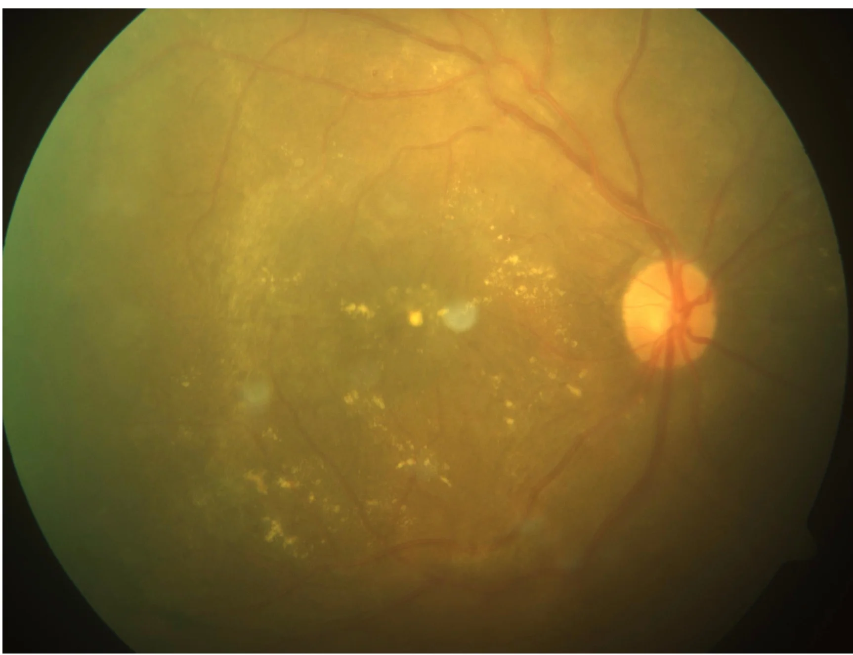 Retina scan diabetic retinopathy