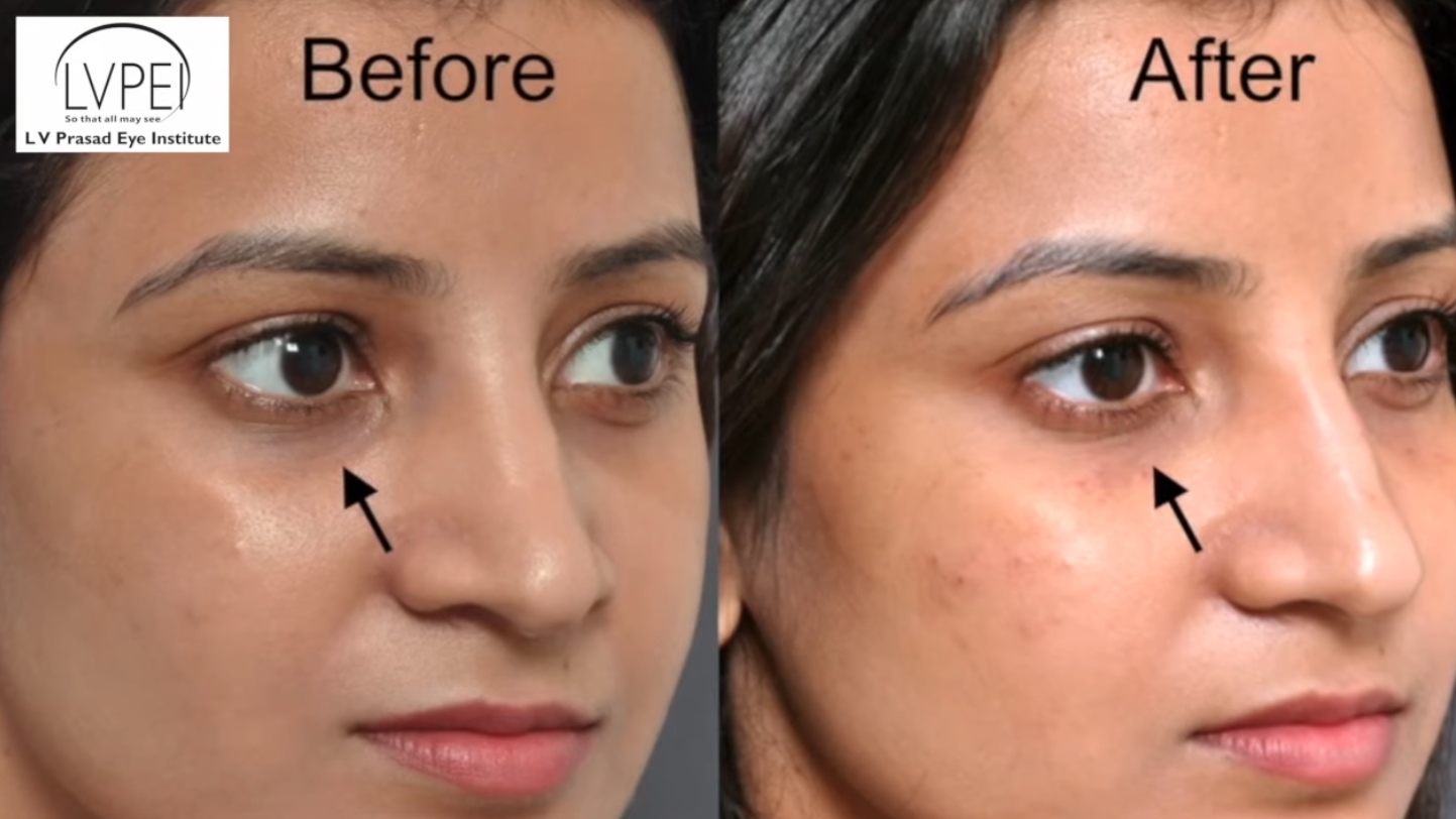 Under eye hollows treated with filler