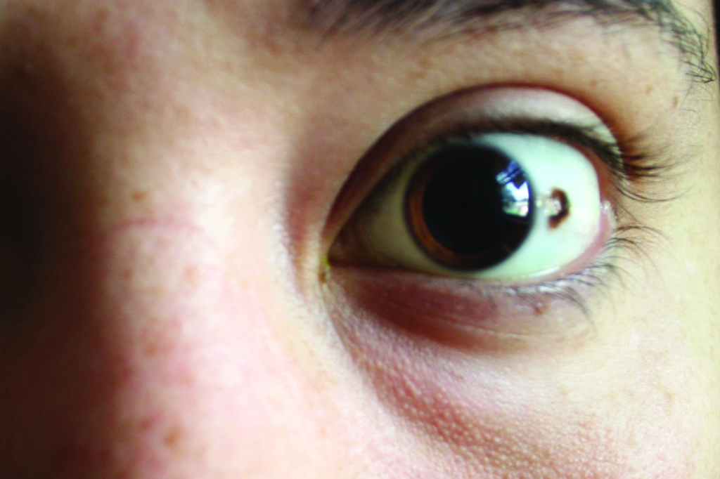 Eye Nevus