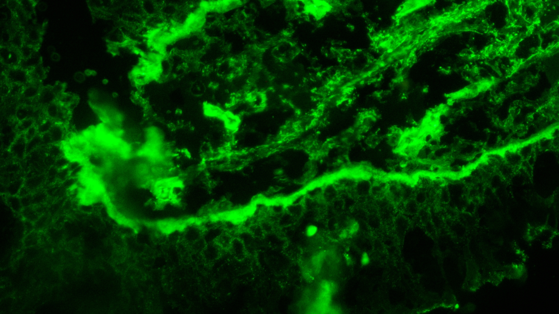 Direct Immunofluorescence result - fibrin